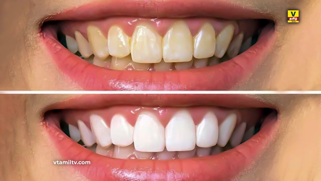 Home Remedies for Yellowing Teeth