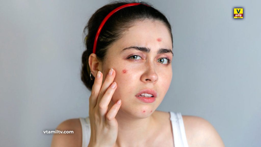 How to Prevent pimples naturally