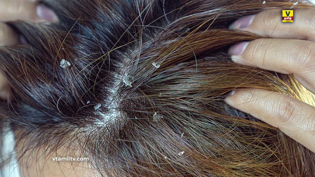 Home Remedies For Rid of Head Lice