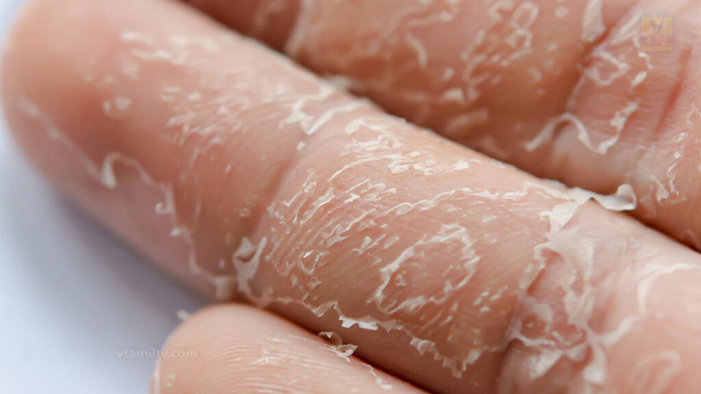 Skin Peeling On Hand