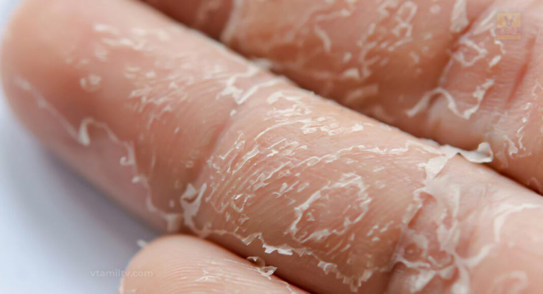 Skin Peeling On Hand